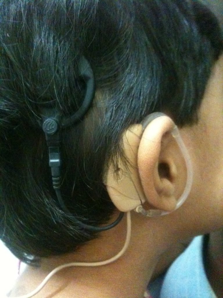 Cochlear Implant Programhearing Restorationmaurya Foundation 1542